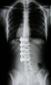 X-ray Spine Surgery