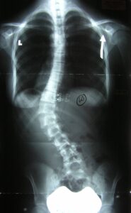 X-ray Spine Surgery